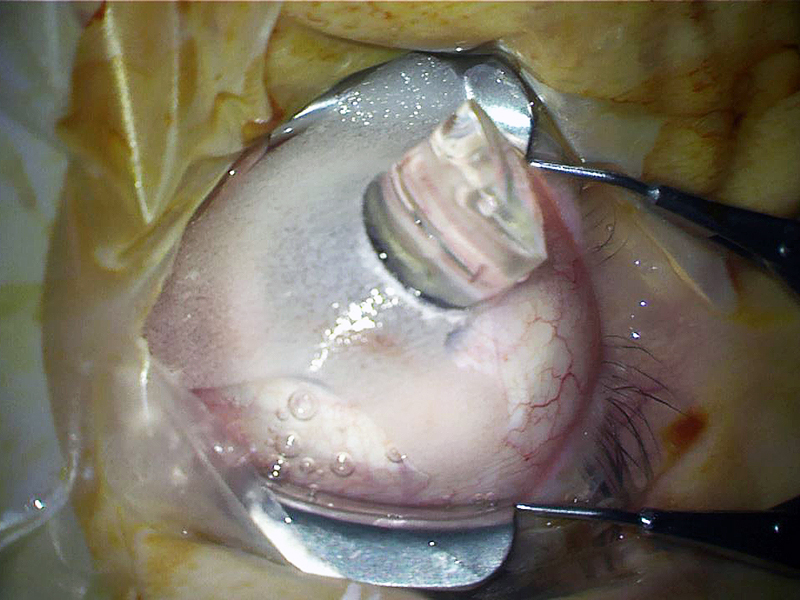 Great Stability of the Lens - Due to Large Contact Surface